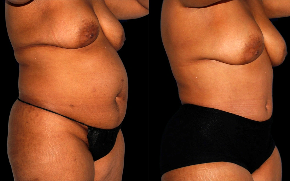 Before and After Photos Chevy Chase, MD Ikon Plastic Surgery and Medical Aesthetics Dr. James Economides