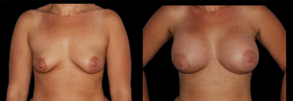 Before and After Photos Chevy Chase, MD Ikon Plastic Surgery and Medical Aesthetics Dr. James Economides