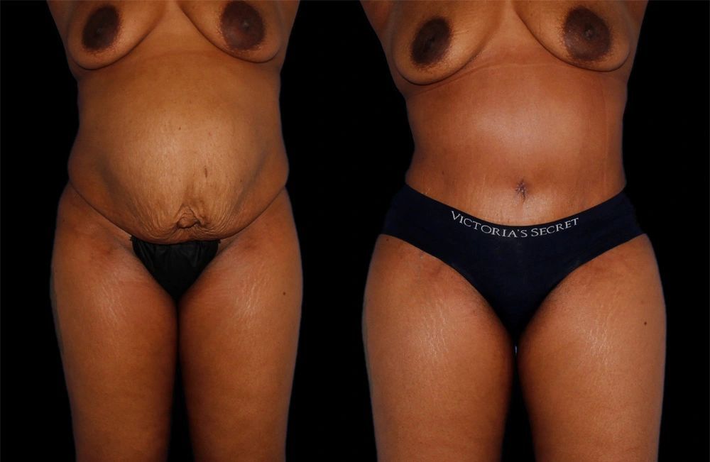 Before and After Photos Chevy Chase, MD Ikon Plastic Surgery and Medical Aesthetics Dr. James Economides