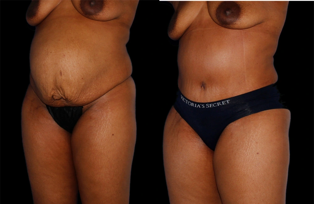 Before and After Photos Chevy Chase, MD Ikon Plastic Surgery and Medical Aesthetics Dr. James Economides