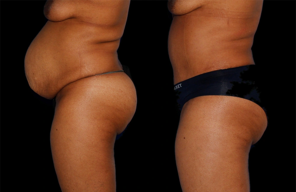 Before and After Photos Chevy Chase, MD Ikon Plastic Surgery and Medical Aesthetics Dr. James Economides