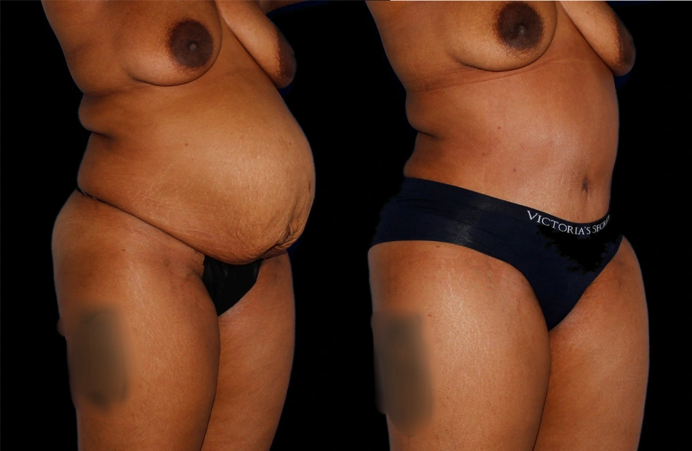 Before and After Photos Chevy Chase, MD Ikon Plastic Surgery and Medical Aesthetics Dr. James Economides