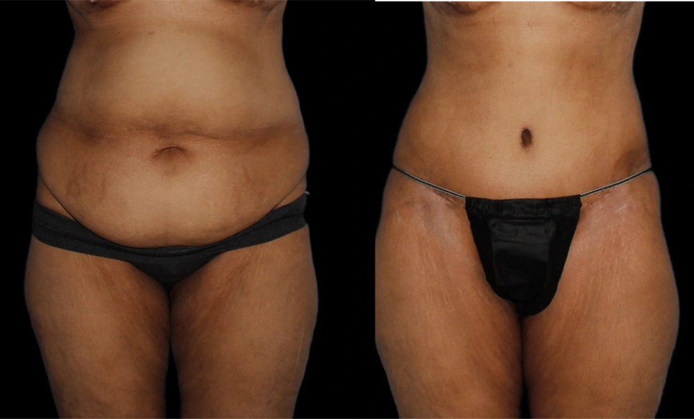 Before and After Photos Chevy Chase, MD Ikon Plastic Surgery and Medical Aesthetics Dr. James Economides