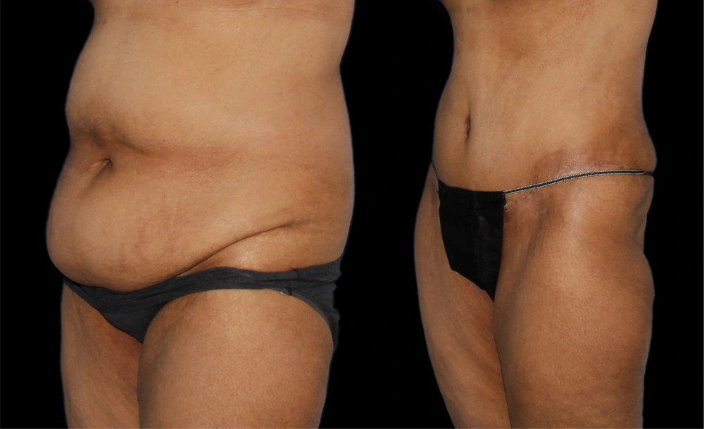 Before and After Photos Chevy Chase, MD Ikon Plastic Surgery and Medical Aesthetics Dr. James Economides