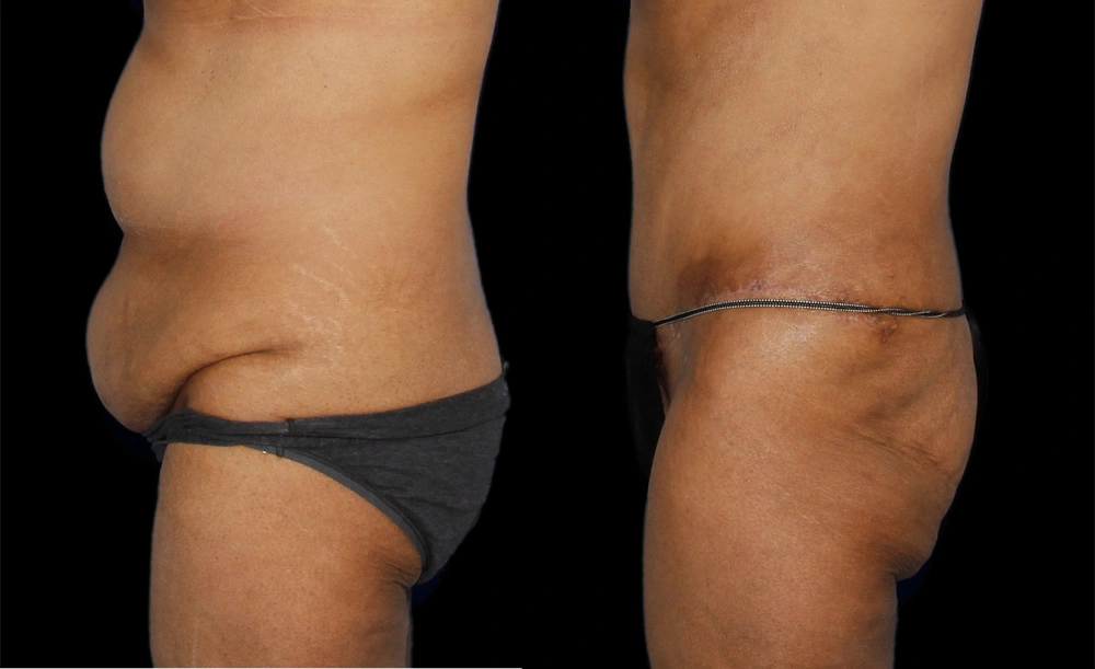 Before and After Photos Chevy Chase, MD Ikon Plastic Surgery and Medical Aesthetics Dr. James Economides