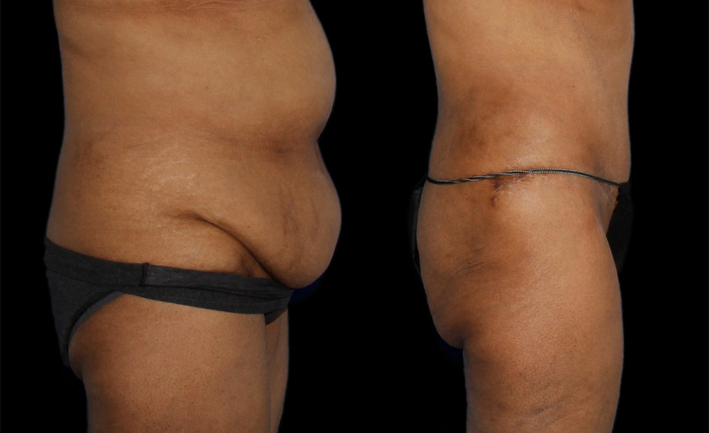 Before and After Photos Chevy Chase, MD Ikon Plastic Surgery and Medical Aesthetics Dr. James Economides