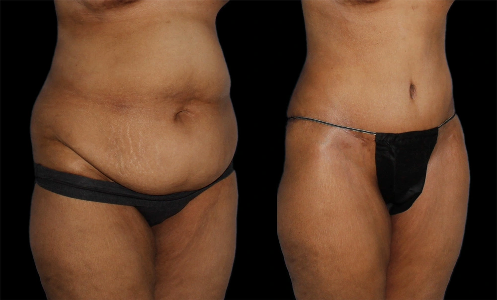 Before and After Photos Chevy Chase, MD Ikon Plastic Surgery and Medical Aesthetics Dr. James Economides