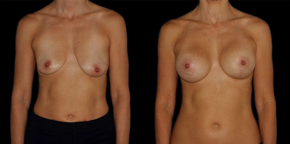 Before and After Photos Chevy Chase, MD Ikon Plastic Surgery and Medical Aesthetics Dr. James Economides