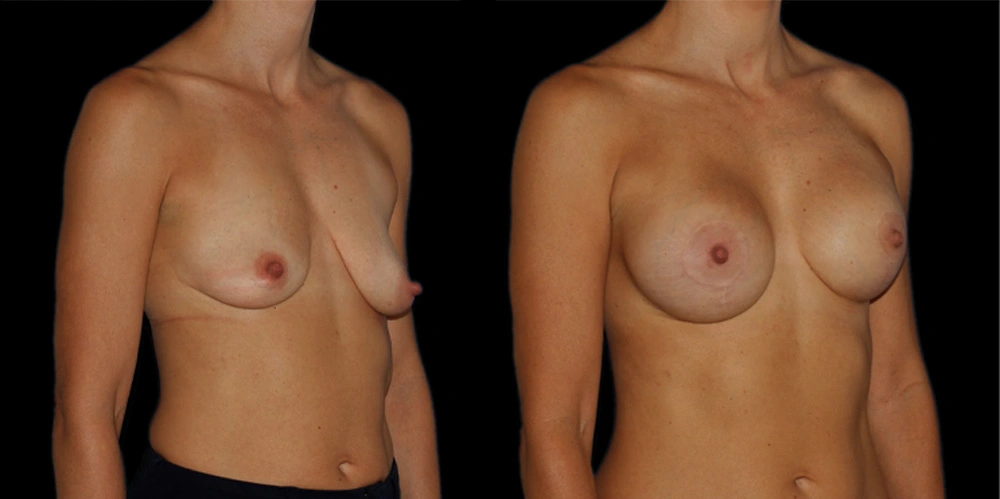 Before and After Photos Chevy Chase, MD Ikon Plastic Surgery and Medical Aesthetics Dr. James Economides