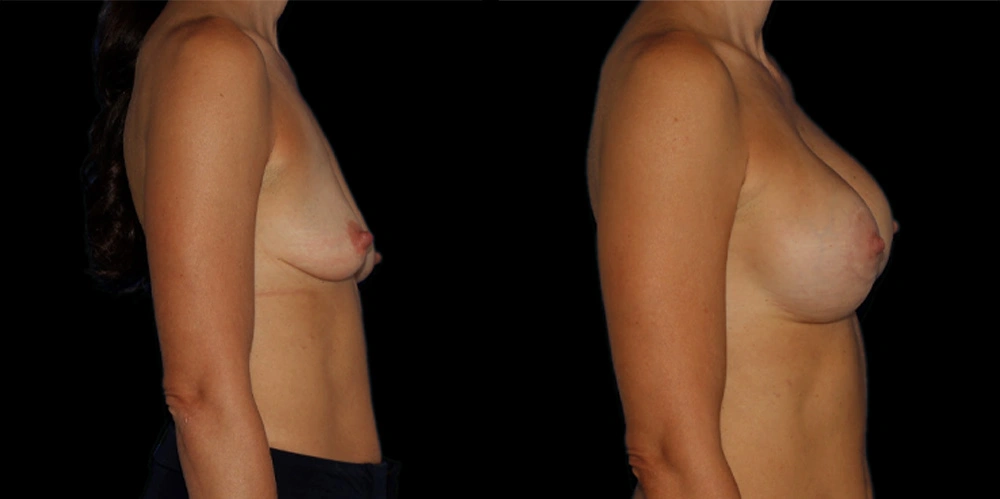 Before and After Photos Chevy Chase, MD Ikon Plastic Surgery and Medical Aesthetics Dr. James Economides