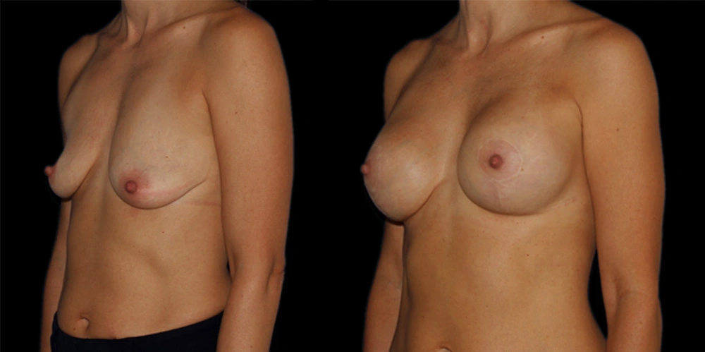 Before and After Photos Chevy Chase, MD Ikon Plastic Surgery and Medical Aesthetics Dr. James Economides