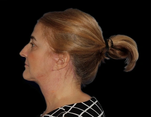 Before and After Photos Chevy Chase, MD Ikon Plastic Surgery and Medical Aesthetics Dr. James Economides