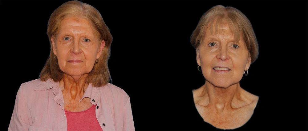 Before and After Photos Chevy Chase, MD Ikon Plastic Surgery and Medical Aesthetics Dr. James Economides