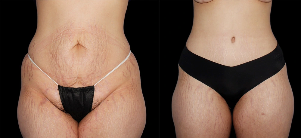 Before and After Photos Chevy Chase, MD Ikon Plastic Surgery and Medical Aesthetics Dr. James Economides