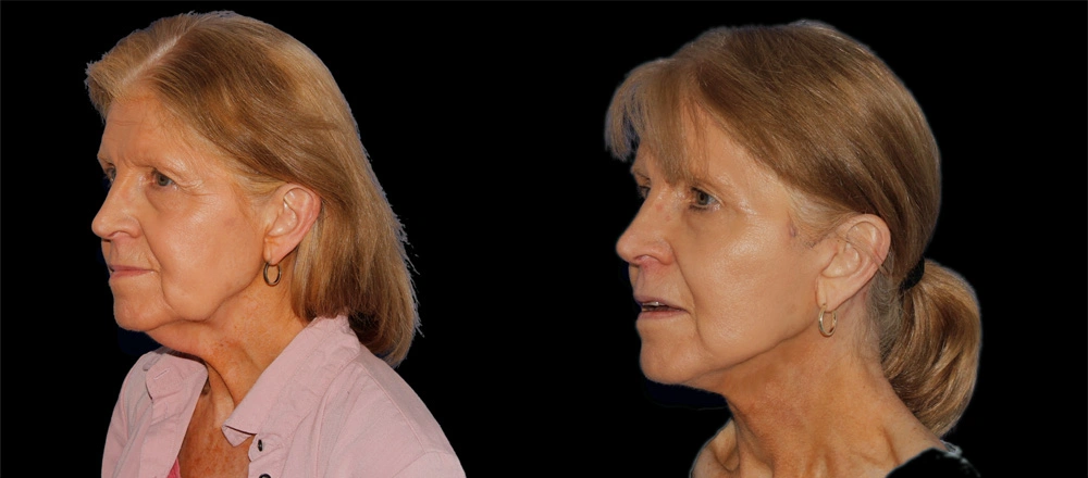 Before and After Photos Chevy Chase, MD Ikon Plastic Surgery and Medical Aesthetics Dr. James Economides