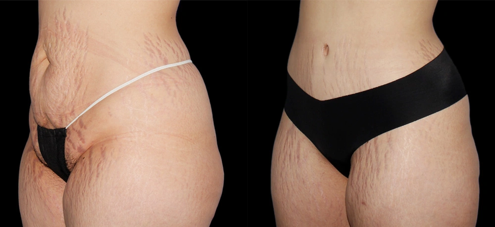 Before and After Photos Chevy Chase, MD Ikon Plastic Surgery and Medical Aesthetics Dr. James Economides