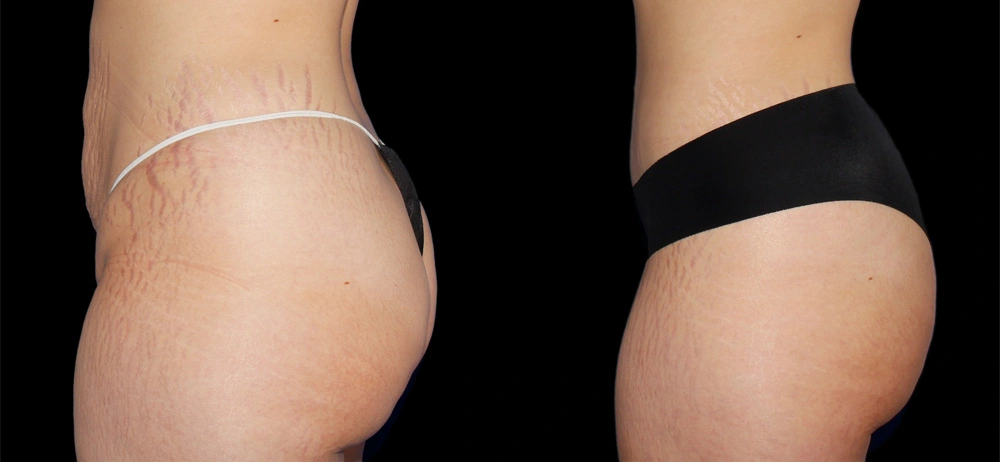 Before and After Photos Chevy Chase, MD Ikon Plastic Surgery and Medical Aesthetics Dr. James Economides