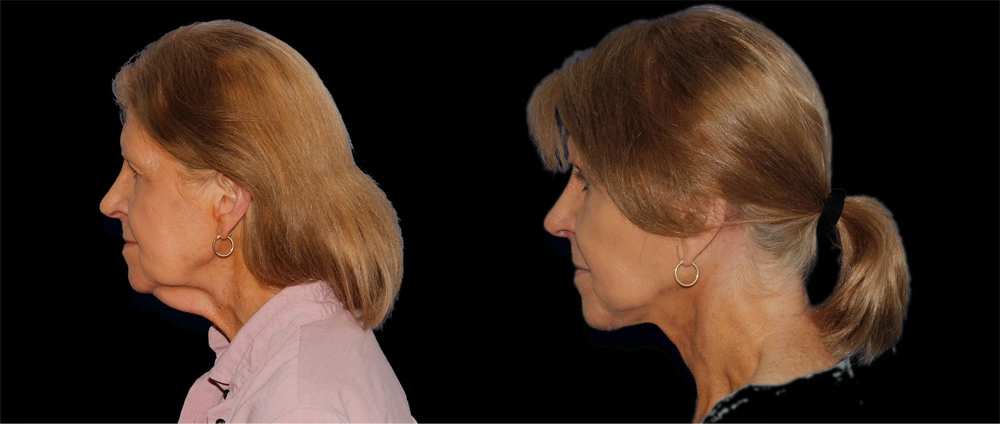 Before and After Photos Chevy Chase, MD Ikon Plastic Surgery and Medical Aesthetics Dr. James Economides