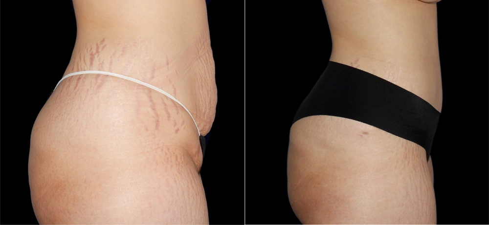 Before and After Photos Chevy Chase, MD Ikon Plastic Surgery and Medical Aesthetics Dr. James Economides