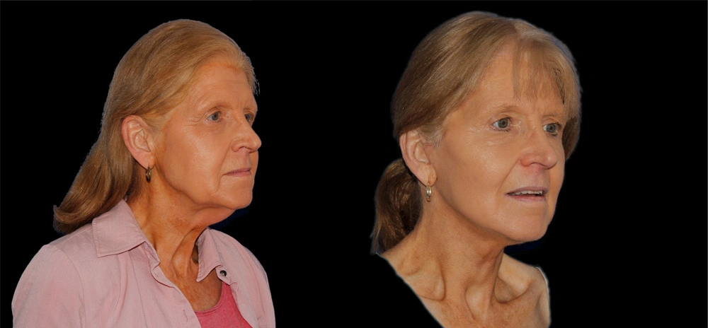 Before and After Photos Chevy Chase, MD Ikon Plastic Surgery and Medical Aesthetics Dr. James Economides