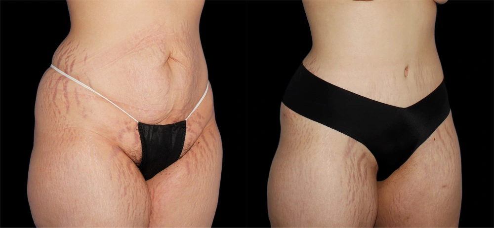 Before and After Photos Chevy Chase, MD Ikon Plastic Surgery and Medical Aesthetics Dr. James Economides