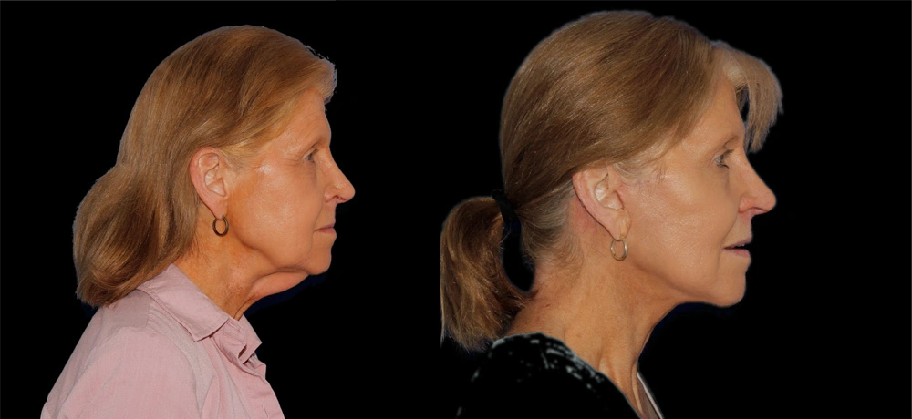 Before and After Photos Chevy Chase, MD Ikon Plastic Surgery and Medical Aesthetics Dr. James Economides