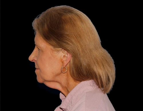 Before and After Photos Chevy Chase, MD Ikon Plastic Surgery and Medical Aesthetics Dr. James Economides