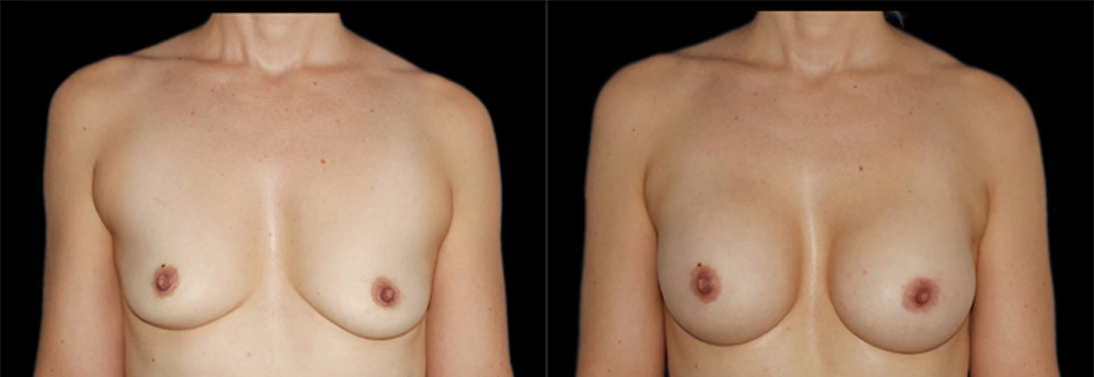 Before and After Photos Chevy Chase, MD Ikon Plastic Surgery and Medical Aesthetics Dr. James Economides