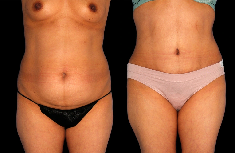 Before and After Photos Chevy Chase, MD Ikon Plastic Surgery and Medical Aesthetics Dr. James Economides