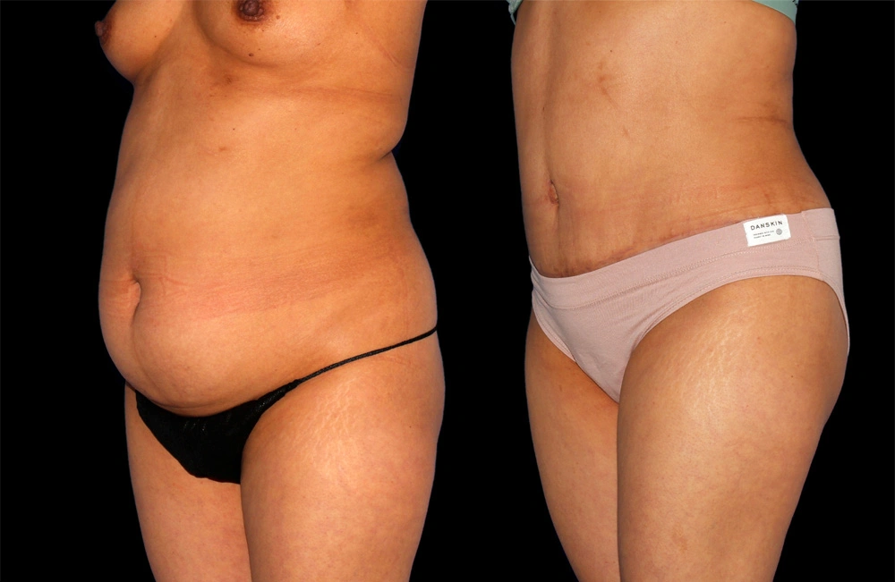 Before and After Photos Chevy Chase, MD Ikon Plastic Surgery and Medical Aesthetics Dr. James Economides