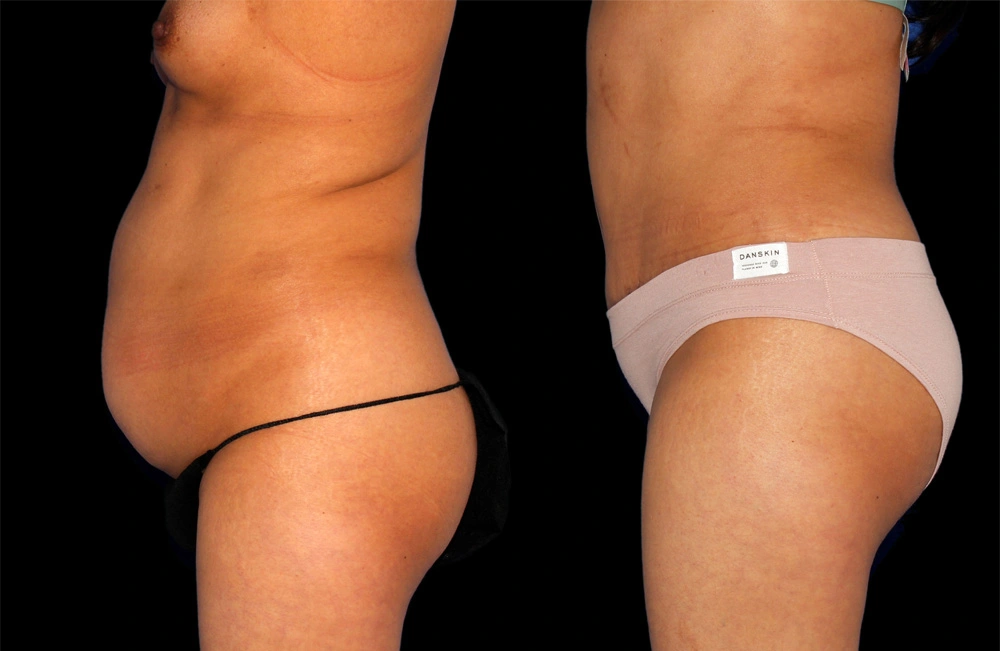 Before and After Photos Chevy Chase, MD Ikon Plastic Surgery and Medical Aesthetics Dr. James Economides