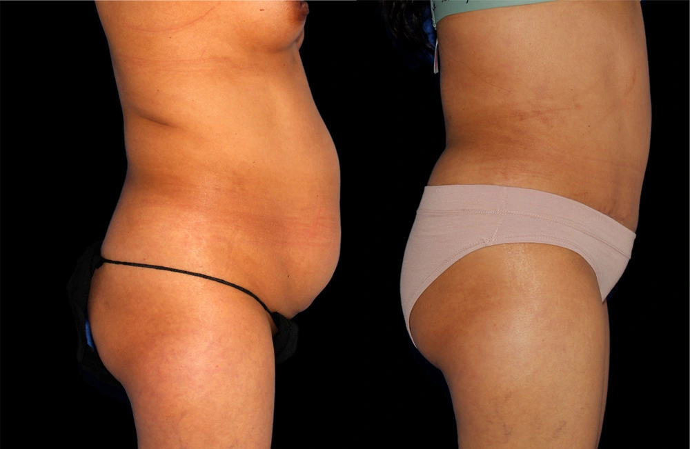 Before and After Photos Chevy Chase, MD Ikon Plastic Surgery and Medical Aesthetics Dr. James Economides