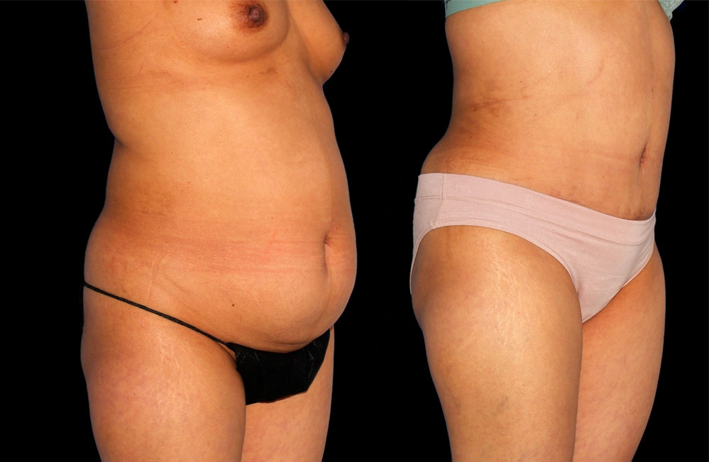 Before and After Photos Chevy Chase, MD Ikon Plastic Surgery and Medical Aesthetics Dr. James Economides