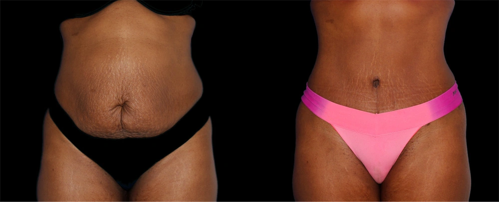 Before and After Photos Chevy Chase, MD Ikon Plastic Surgery and Medical Aesthetics Dr. James Economides
