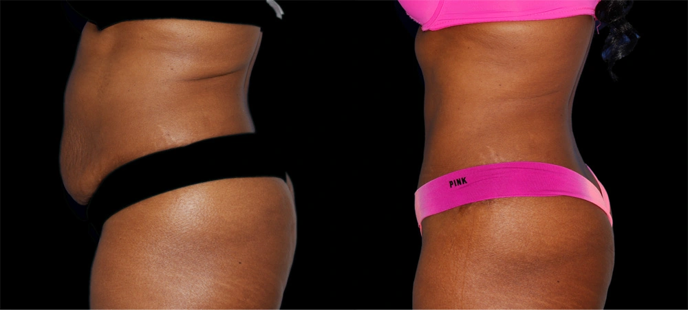 Before and After Photos Chevy Chase, MD Ikon Plastic Surgery and Medical Aesthetics Dr. James Economides