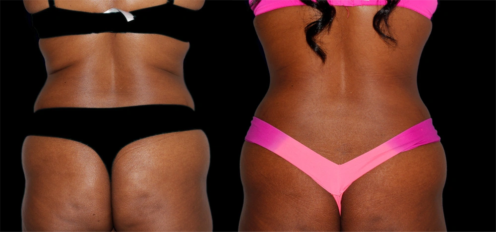 Before and After Photos Chevy Chase, MD Ikon Plastic Surgery and Medical Aesthetics Dr. James Economides