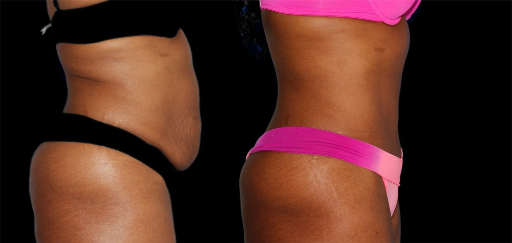 Before and After Photos Chevy Chase, MD Ikon Plastic Surgery and Medical Aesthetics Dr. James Economides