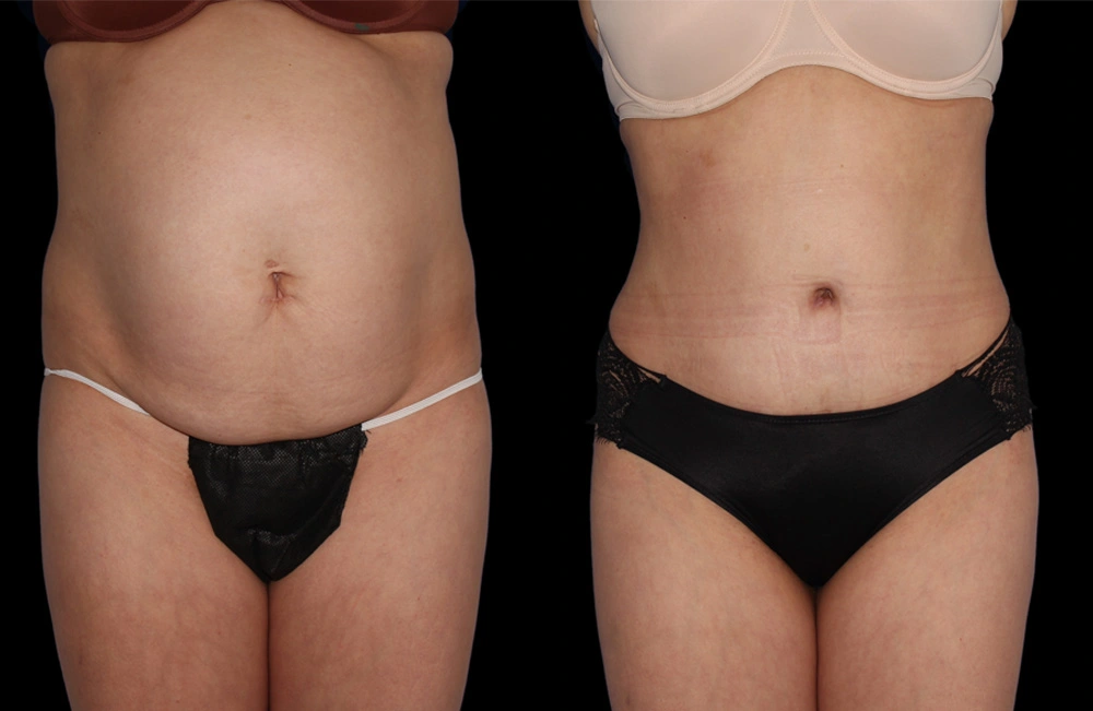 Before and After Photos Chevy Chase, MD Ikon Plastic Surgery and Medical Aesthetics Dr. James Economides