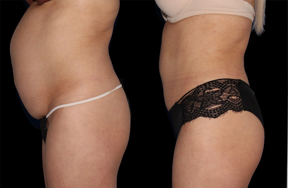 Before and After Photos Chevy Chase, MD Ikon Plastic Surgery and Medical Aesthetics Dr. James Economides