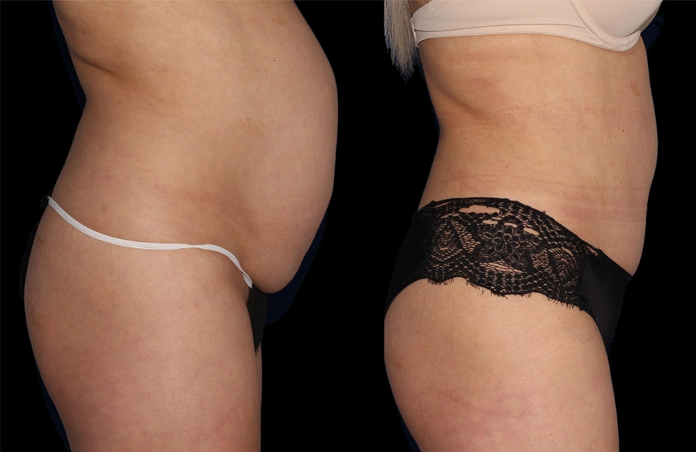 Before and After Photos Chevy Chase, MD Ikon Plastic Surgery and Medical Aesthetics Dr. James Economides