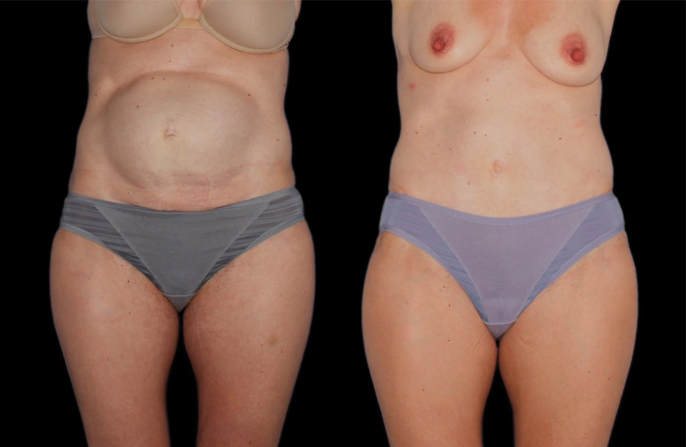Before and After Photos Chevy Chase, MD Ikon Plastic Surgery and Medical Aesthetics Dr. James Economides