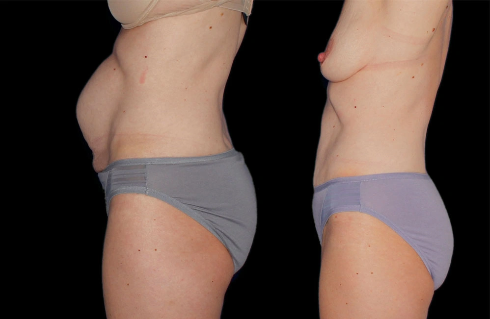 Before and After Photos Chevy Chase, MD Ikon Plastic Surgery and Medical Aesthetics Dr. James Economides