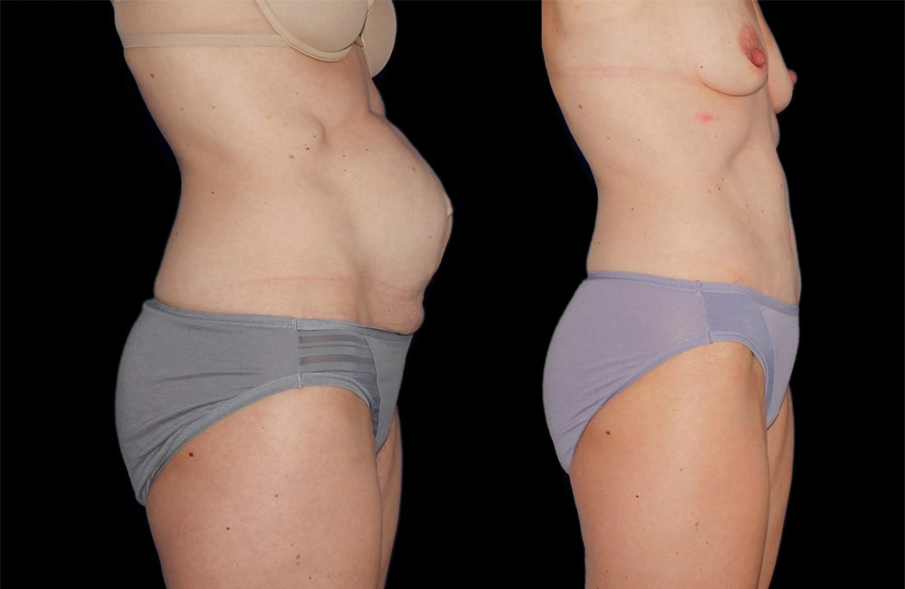 Before and After Photos Chevy Chase, MD Ikon Plastic Surgery and Medical Aesthetics Dr. James Economides