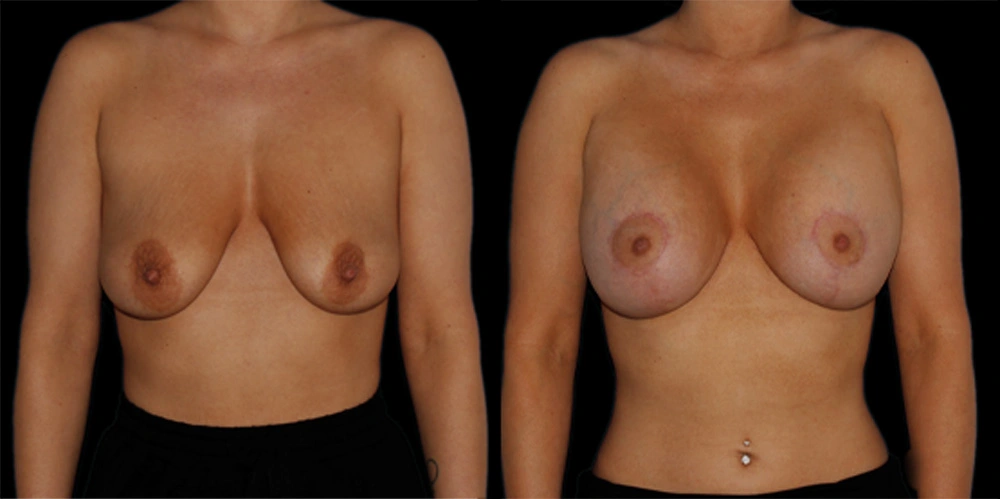 Before and After Photos Chevy Chase, MD Ikon Plastic Surgery and Medical Aesthetics Dr. James Economides