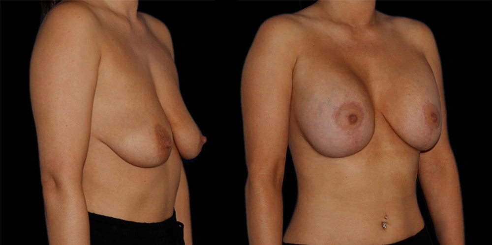 Before and After Photos Chevy Chase, MD Ikon Plastic Surgery and Medical Aesthetics Dr. James Economides