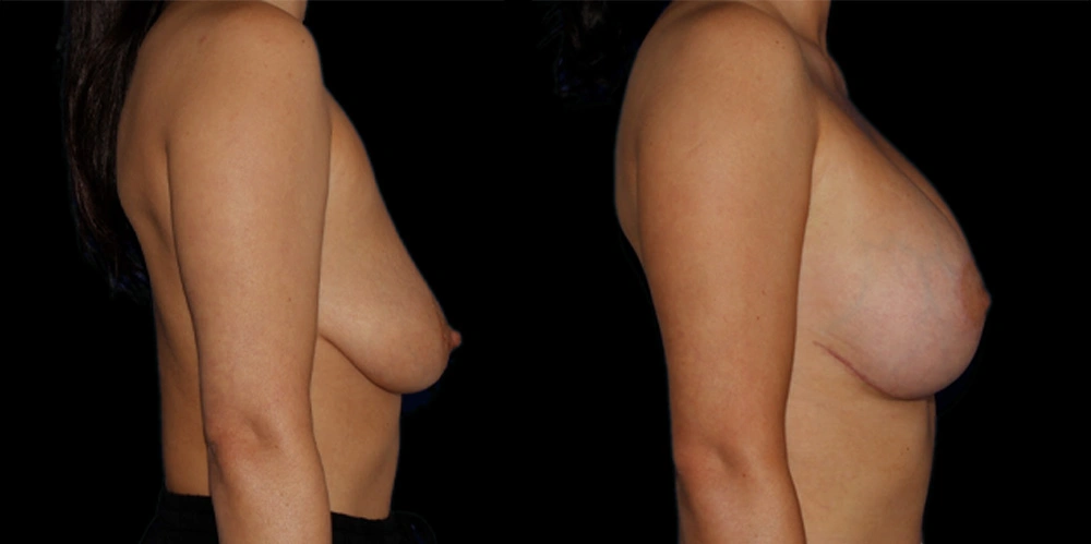 Before and After Photos Chevy Chase, MD Ikon Plastic Surgery and Medical Aesthetics Dr. James Economides