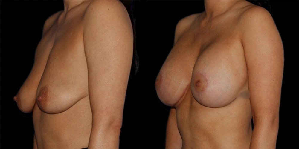 Before and After Photos Chevy Chase, MD Ikon Plastic Surgery and Medical Aesthetics Dr. James Economides