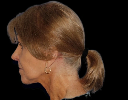 Before and After Photos Chevy Chase, MD Ikon Plastic Surgery and Medical Aesthetics Dr. James Economides