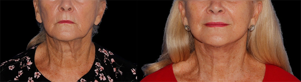 Before and After Photos Chevy Chase, MD Ikon Plastic Surgery and Medical Aesthetics Dr. James Economides