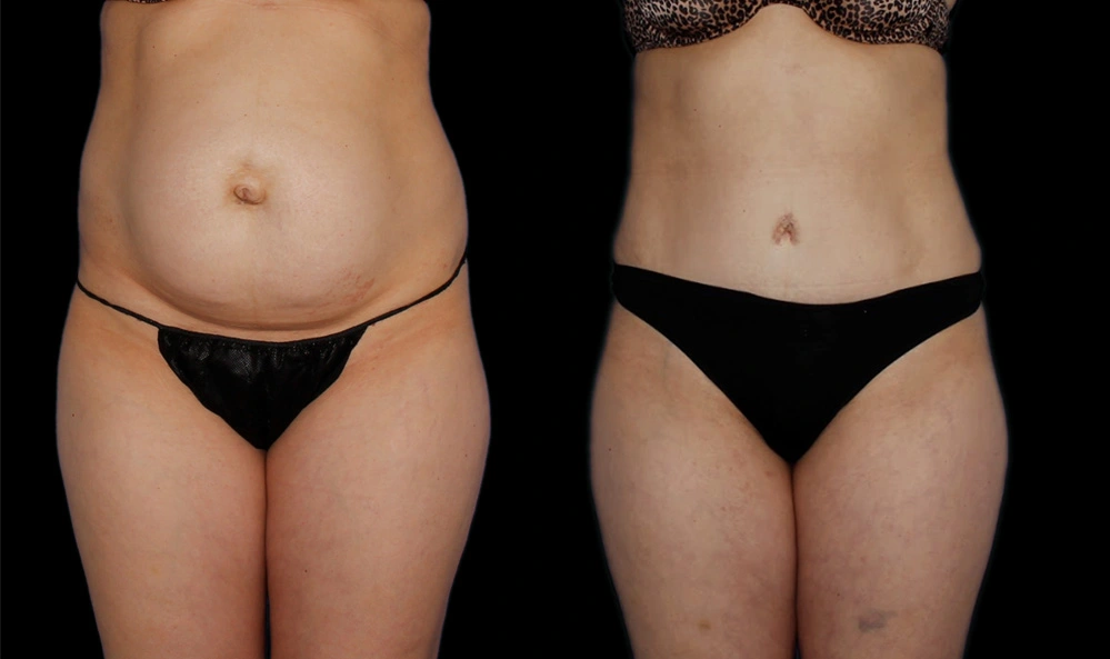 Before and After Photos Chevy Chase, MD Ikon Plastic Surgery and Medical Aesthetics Dr. James Economides